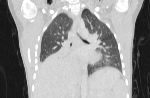 Bronchial mucoepidermoid carcinoma (Radiopaedia 57023-63895 Coronal lung window 25).jpg