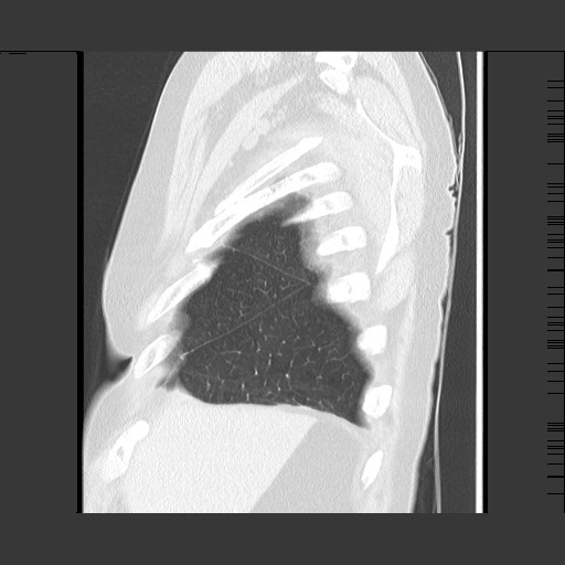 Bronchial stenosis - lung transplant (Radiopaedia 73133-83848 Sagittal lung window 12).jpg