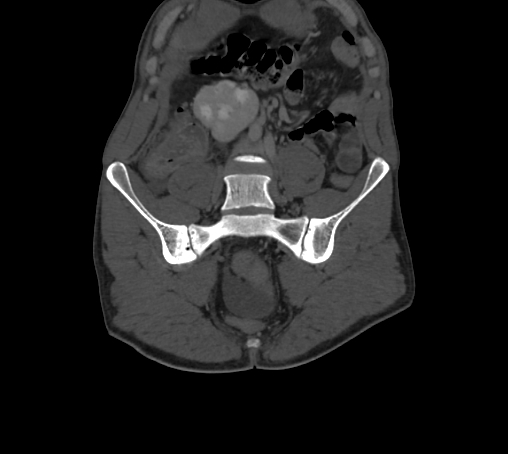 File:Bronchiectasis in Crohn disease (Radiopaedia 60311-67977 Coronal bone window 13).jpg