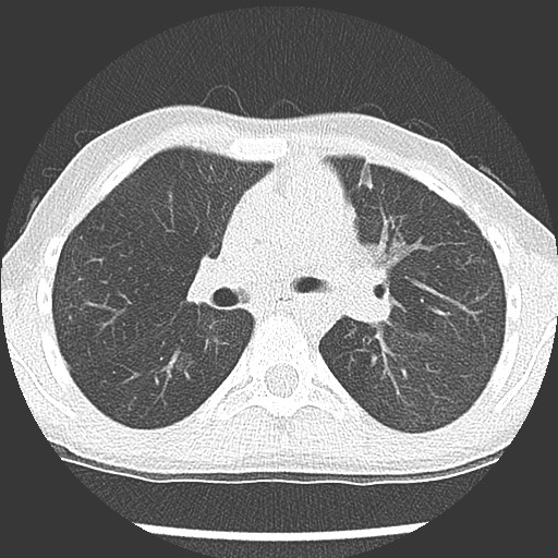 Bronchiolotis obliterans (Radiopaedia 73769-84575 Axial lung window 21).jpg