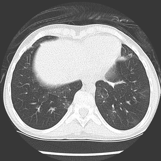 File:Bronchiolotis obliterans (Radiopaedia 73769-84575 Axial lung window 38).jpg