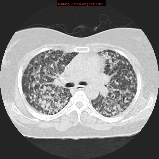 File:Bronchoalveolar carcinoma (Radiopaedia 13224-13233 Axial lung window 19).jpg