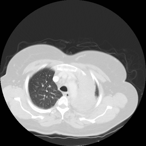 Bronchogenic carcinoma (Radiopaedia 73497-84262 Axial lung window 23).jpg