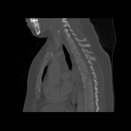 Bronchogenic carcinoma (Radiopaedia 73497-84262 Sagittal bone window 81).jpg