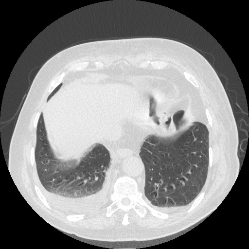 Bronchogenic carcinoma with metastatic lymphadenopathy (Radiopaedia 37671-39569 Axial lung window 44).jpg