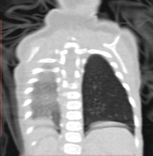 Bronchogenic cyst (Radiopaedia 78599-91409 Coronal lung window 182).jpg