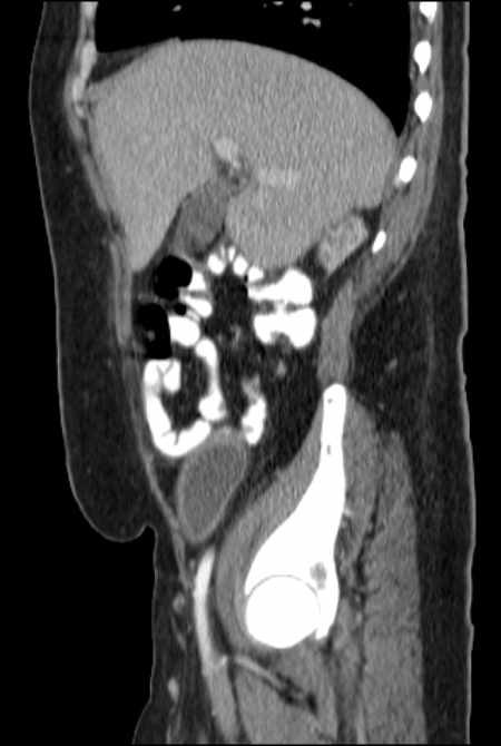 Brown tumors compressing the spinal cord (Radiopaedia 68442-77988 F 17).jpg