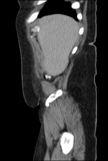 Brown tumors compressing the spinal cord (Radiopaedia 68442-77988 F 8).jpg