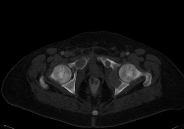 Brown tumors compressing the spinal cord (Radiopaedia 68442-77988 G 123).jpg