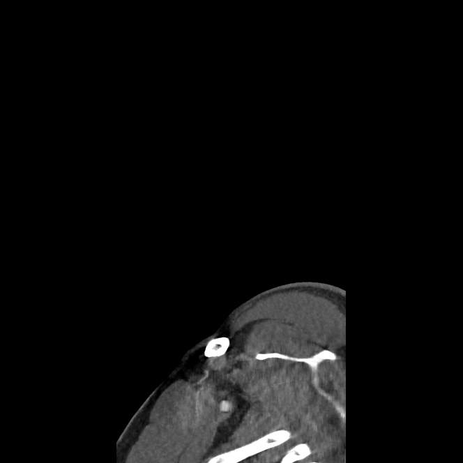 Buccal fat pad arteriovenous malformation (Radiopaedia 70936-81144 C 8).jpg