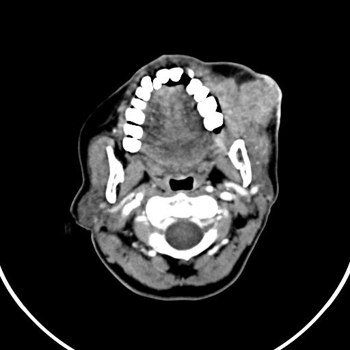 File:Buccal squamous cell carcinoma (Radiopaedia 8520-9346 A 16).jpg