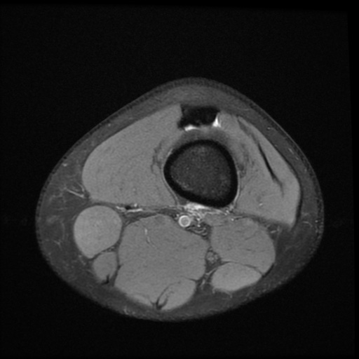 File:Bucket-handle meniscus tear (Radiopaedia 65700-74809 Axial PD fat sat 1).jpg
