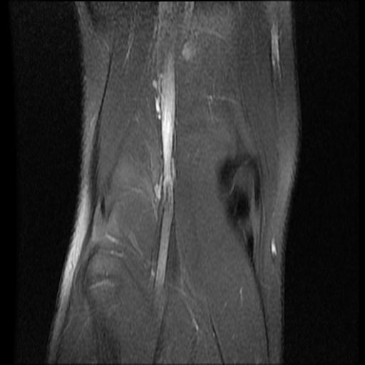 File:Bucket handle tear - lateral meniscus (Radiopaedia 72124-82634 Coronal PD fat sat 15).jpg