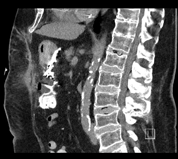 Buried bumper syndrome - gastrostomy tube (Radiopaedia 63843-72577 Sagittal Inject 61).jpg
