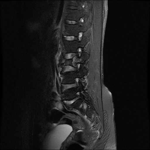 File:Burst fracture - lumbar spine (Radiopaedia 72877-83541 Sagittal STIR 2).jpg