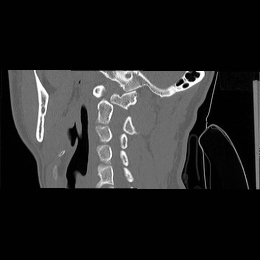 File:C1-C2 "subluxation" - normal cervical anatomy at maximum head rotation (Radiopaedia 42483-45607 C 41).jpg