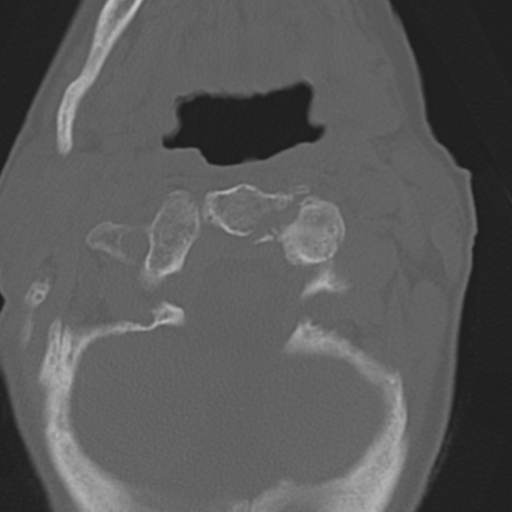 File:C2 fracture with vertebral artery dissection (Radiopaedia 37378-39199 Axial bone window 14).png