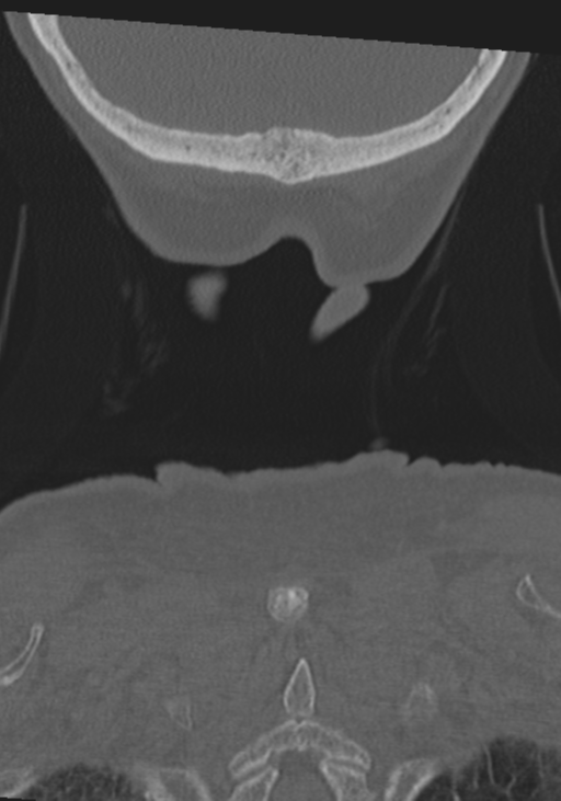 C2 fracture with vertebral artery dissection (Radiopaedia 37378-39199 Coronal bone window 62).png