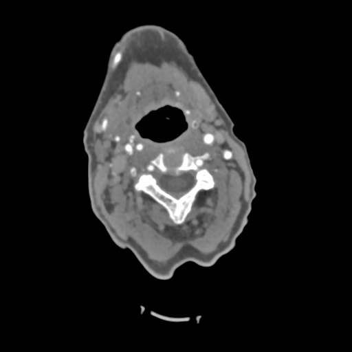 File:C2 fracture with vertebral artery dissection (Radiopaedia 37378-39200 A 151).png