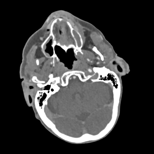 C2 fracture with vertebral artery dissection (Radiopaedia 37378-39200 A 202).png