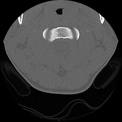 File:C5 facet fracture (Radiopaedia 58374-65499 Axial bone window 20).jpg