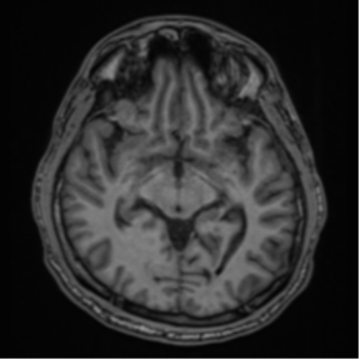 CNS vasculitis (Radiopaedia 55715-62263 Axial T1 18).png