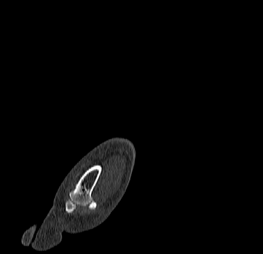 Calcaneal fracture - Sanders type 4 (Radiopaedia 90179-107370 Sagittal bone window 16).jpg