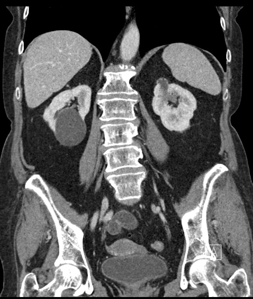 Calcified adrenal glands and Spigelian hernia (Radiopaedia 49741-54988 B 73).jpg