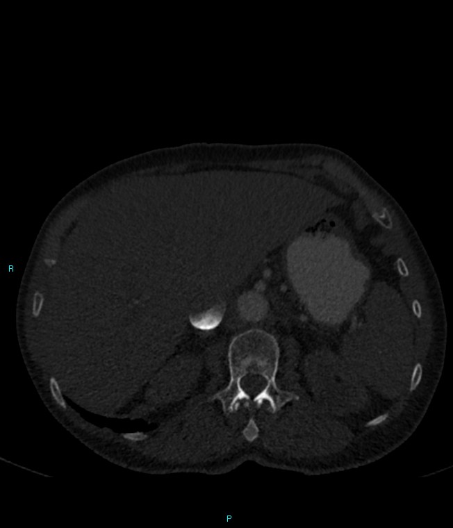 Calcified cerebral emboli from left ventricular thrombus (Radiopaedia 84420-99760 Axial bone window 84).jpg