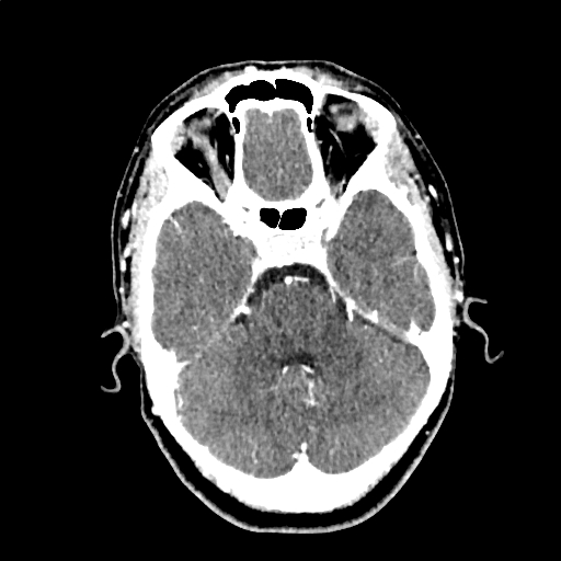 File:Calcified cerebral hydatid cyst (Radiopaedia 65603-74717 Axial with contrast 18).jpg