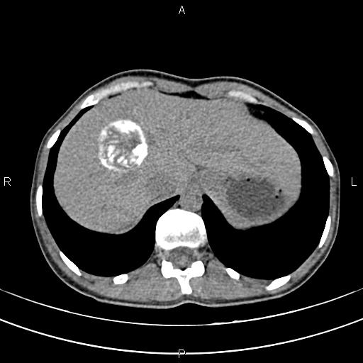 File:Calcified hepatic hydatid cyst (Radiopaedia 83870-99072 Axial non-contrast 27).jpg