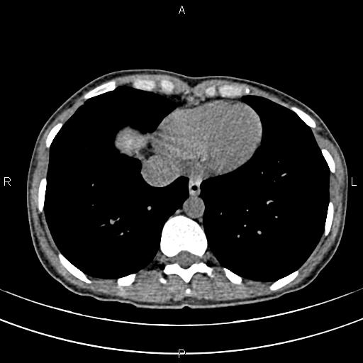 File:Calcified hepatic hydatid cyst (Radiopaedia 83870-99072 Axial non-contrast 7).jpg