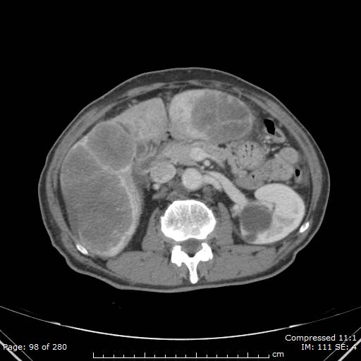 Calcified liver metastases (Radiopaedia 44699-48470 B 35).jpg