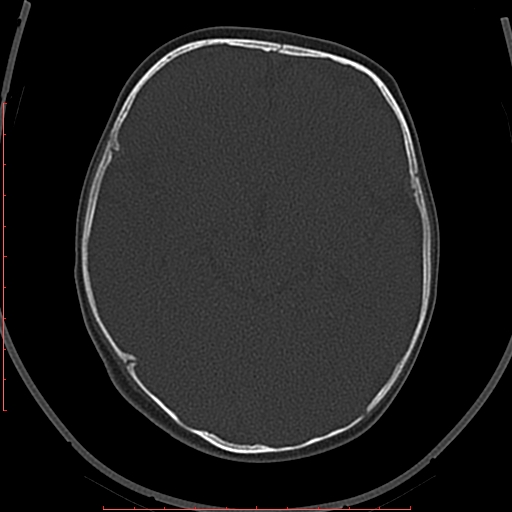 Calcified middle cerebral artery embolism (Radiopaedia 78949-91860 Axial bone window 24).jpg