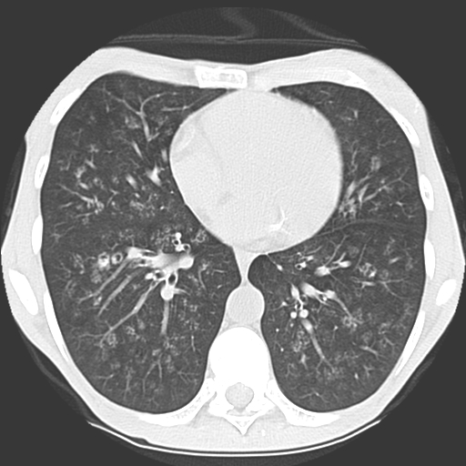 File:Calciphylaxis and metastatic pulmonary calcification (Radiopaedia 10887-11317 Axial lung window 28).jpg