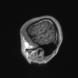 Callosal dysgenesis with interhemispheric cyst (Radiopaedia 53355-59335 Sagittal T1 21).jpg