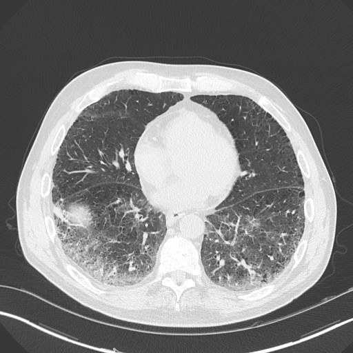 Caplan syndrome (Radiopaedia 56667-63530 Axial lung window 130).jpg