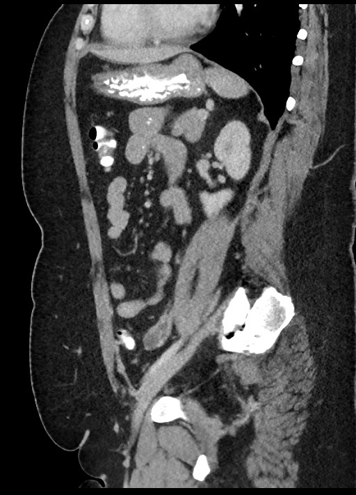 Carcinoid tumor - terminal ileum (Radiopaedia 60931-68739 C 31).jpg