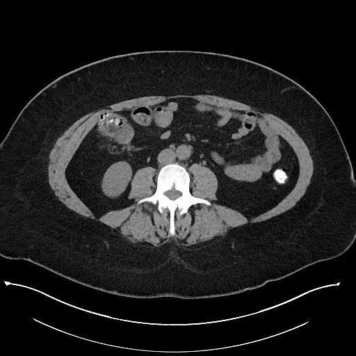 File:Carcinoid tumor - terminal ileum (Radiopaedia 60931-68740 Axial non-contrast 62).jpg