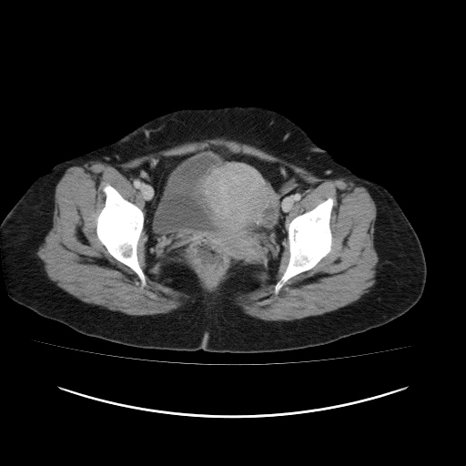 Carcinoma colon - hepatic flexure (Radiopaedia 19461-19493 A 118).jpg