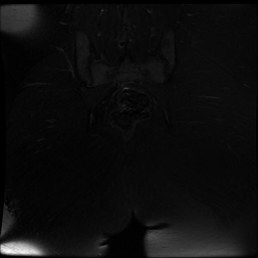 File:Carcinoma of the cervix (Radiopaedia 89018-105858 Coronal T2 fat sat 16).jpg