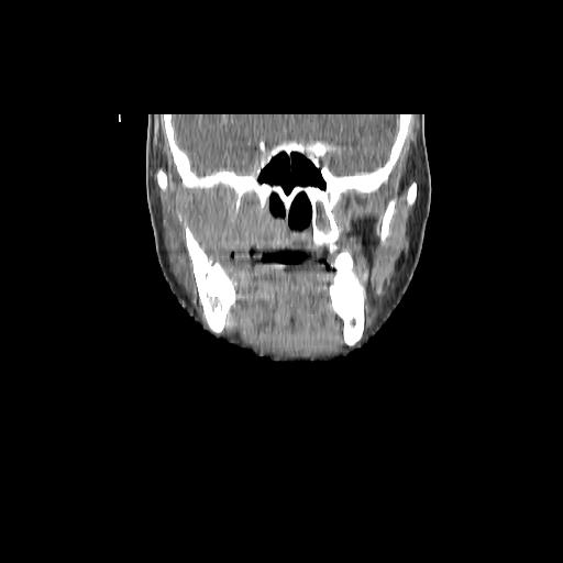 Carcinoma of the maxillary antrum (Radiopaedia 53805-59888 Coronal C+ delayed 62).jpg