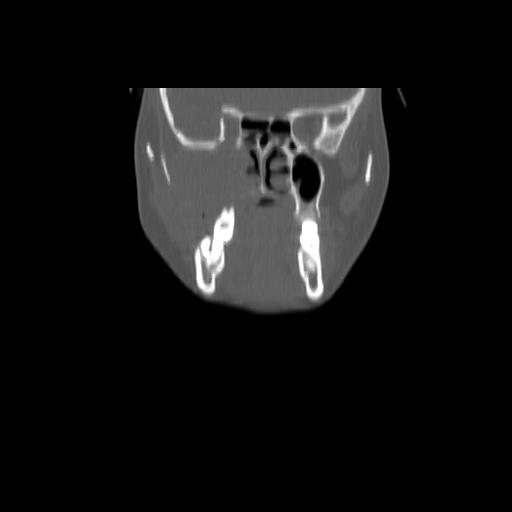 Carcinoma of the maxillary antrum (Radiopaedia 53805-59888 Coronal bone window 48).jpg