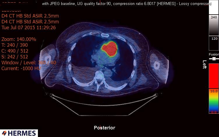 File:Cardiac lymphoma (Radiopaedia 38690-40871 Integrated PET-CT 8).jpg