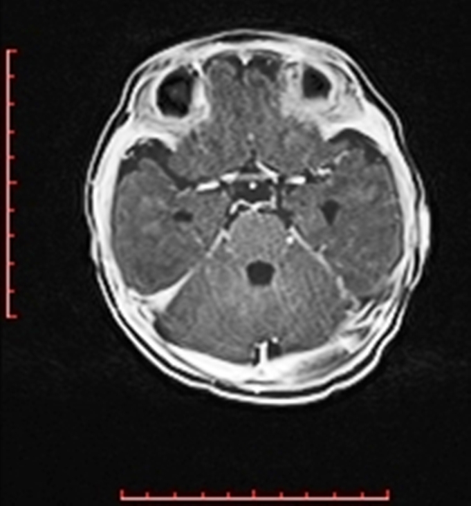 Cardiac rhabdomyoma - tuberous sclerosis (Radiopaedia 70089-80114 Axial T1 C+ fat sat 19).jpg