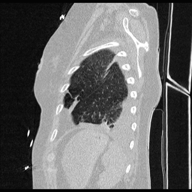 Cardiogenic pulmonary edema (Radiopaedia 29213-29609 Sagittal lung window 82).jpg