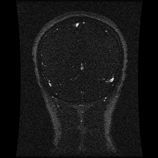 Carotid arterial dissection with acute cerebral infarction (Radiopaedia 26636-26784 MRV 58).jpg
