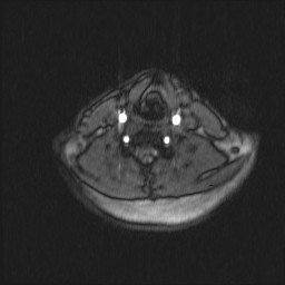 Carotid artery dissection (Radiopaedia 28441-28689 Axial MRA 31).jpg