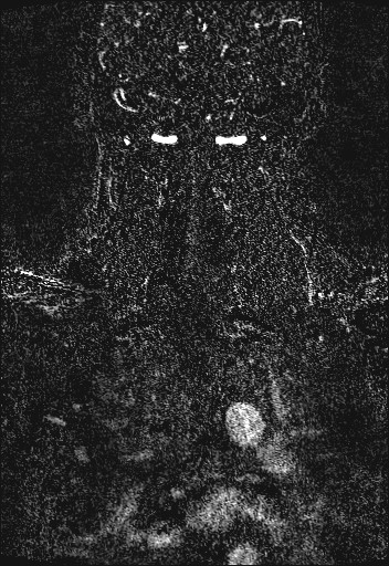 Carotid artery dissection (Radiopaedia 28441-28689 Coronal MRA 83).jpg