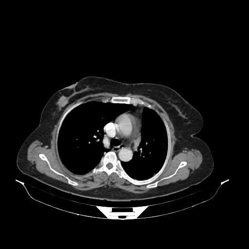 File:Carotid body tumor (Radiopaedia 21021-20948 B 34).jpg